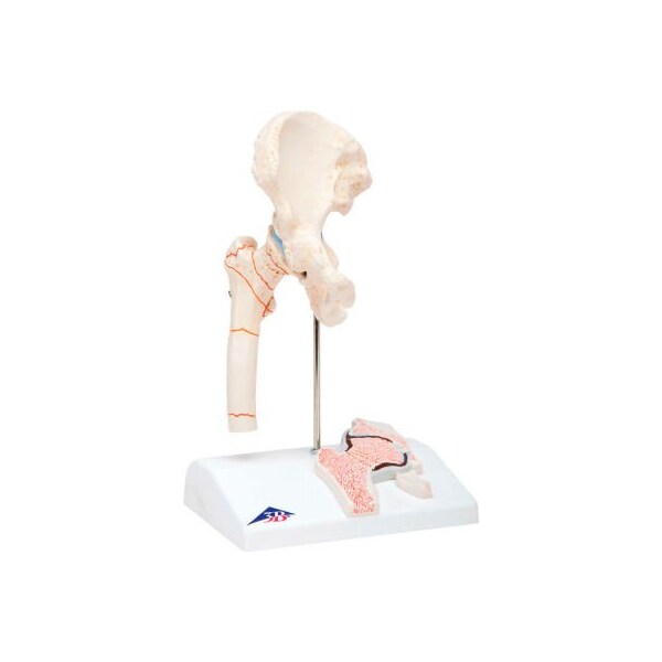 3B Anatomical Model - Femoral Fracture and Hip Osteoarthritis